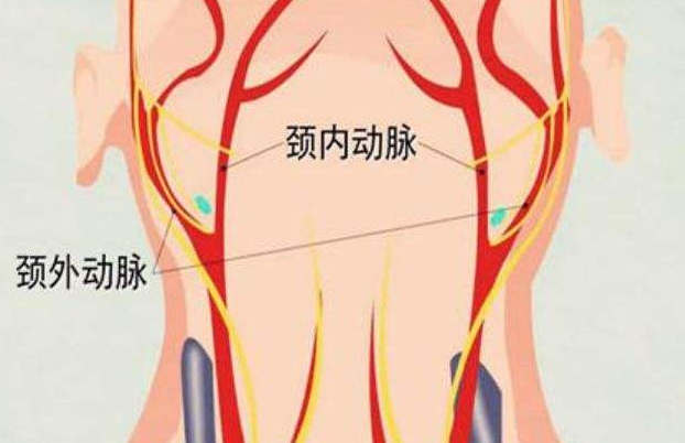 颈动脉是心脑连接生命线